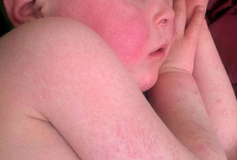 دکتر تب مخملک - اهواز